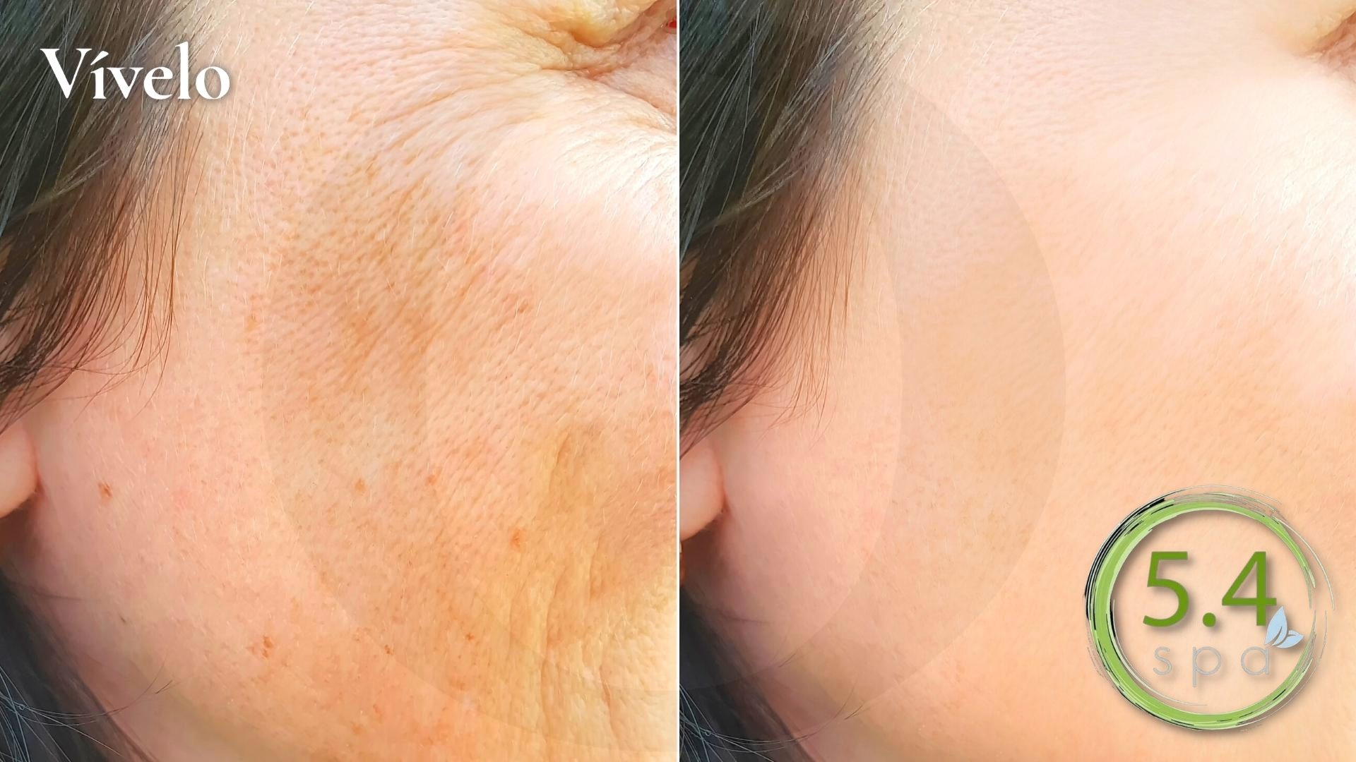 5 4 Spa Laser Clinic Separa Con 39 3 Sesiones L ser Para Eliminar 5-4-spa-laser-clinic-separa-con-39-3-sesiones-l-ser-para-eliminar